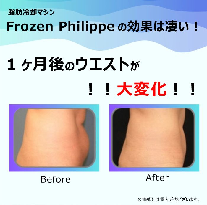 Frozen Philippe (フローズンフィリップ) 冷却マシン