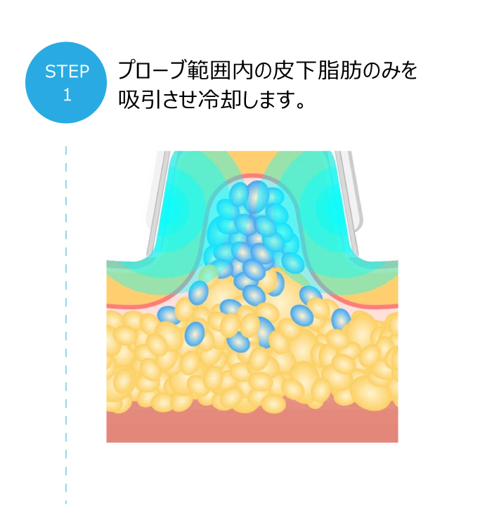 Frozen Philippe (フローズンフィリップ) 冷却マシン