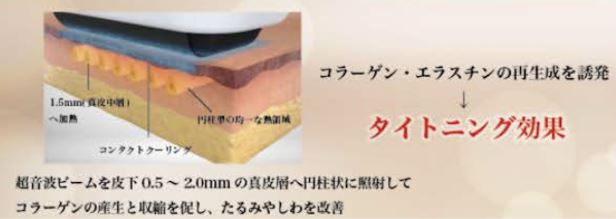 HIRF WAVE技術