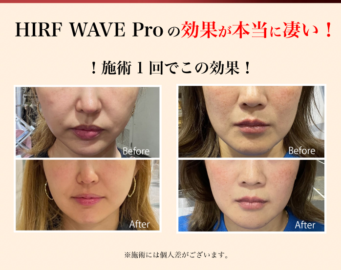 HIRF WAVE SERIES (ハイアールエフウェーブ) シワ・たるみ集中ケア  